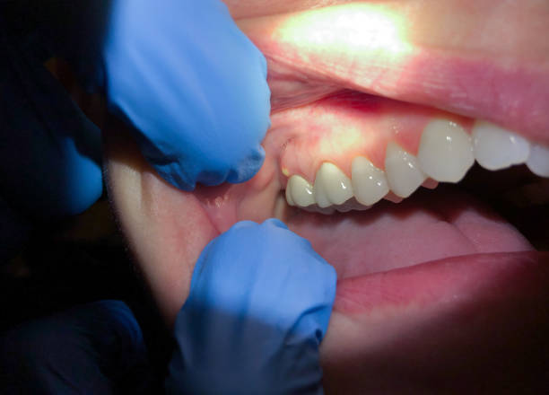 Best Emergency Dentist for Lost Fillings or Crowns in Willow Grove, PA