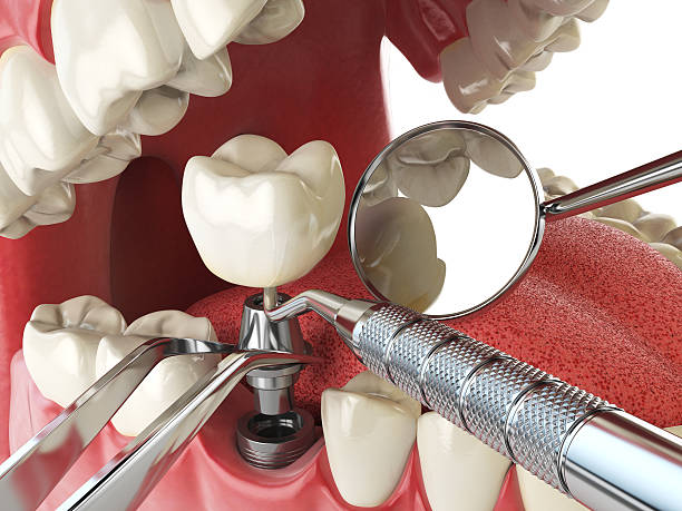 Best Emergency Dentist for Lost Fillings or Crowns in Willow Grove, PA